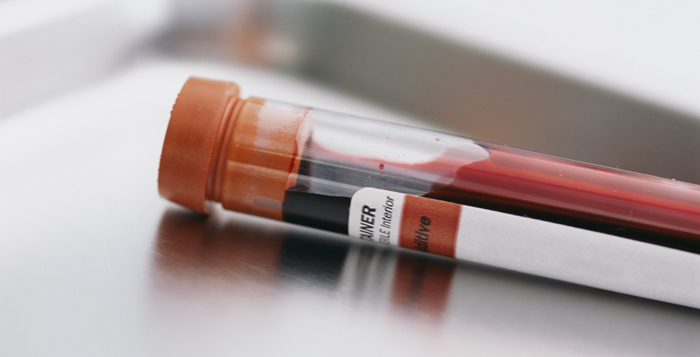 Nuevo test detecta el cáncer de colon con muestra de sangre