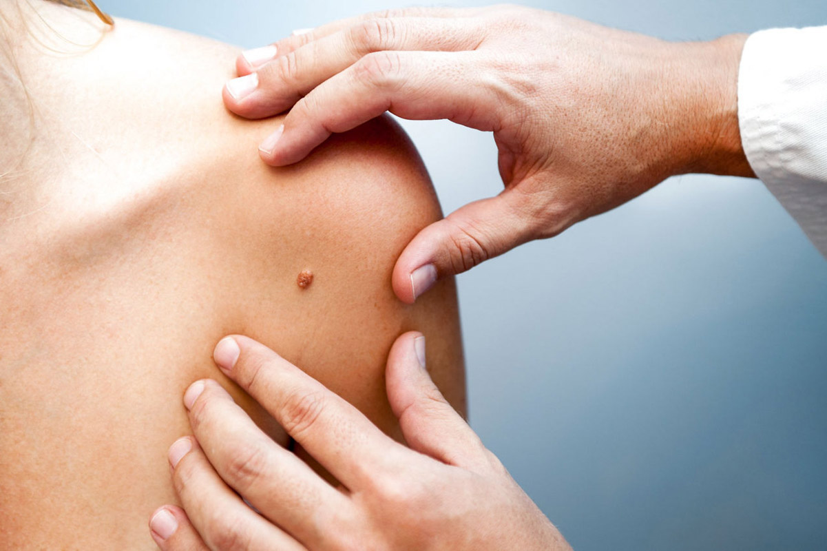 Novedosa terapia cura el 92 % de pacientes de cáncer de piel