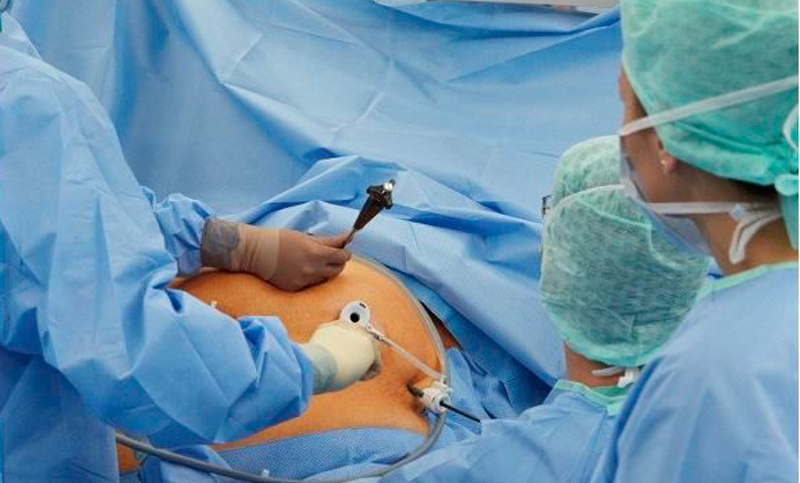 Cirugía bariátrica: achicarse el estómago no es mágico pero salva vidas