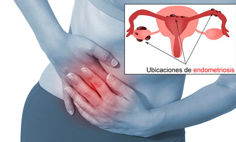 Endometriosis: la enfermedad autoinmune del siglo XXI