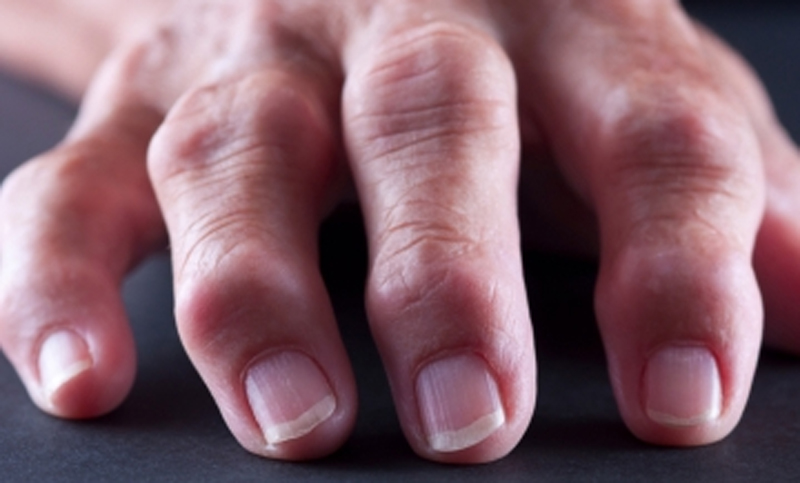 Reconocer los cinco síntomas más comunes de la artrosis