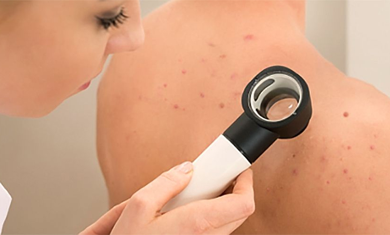 Realizan detección gratuita de una dolorosa enfermedad que afecta la piel