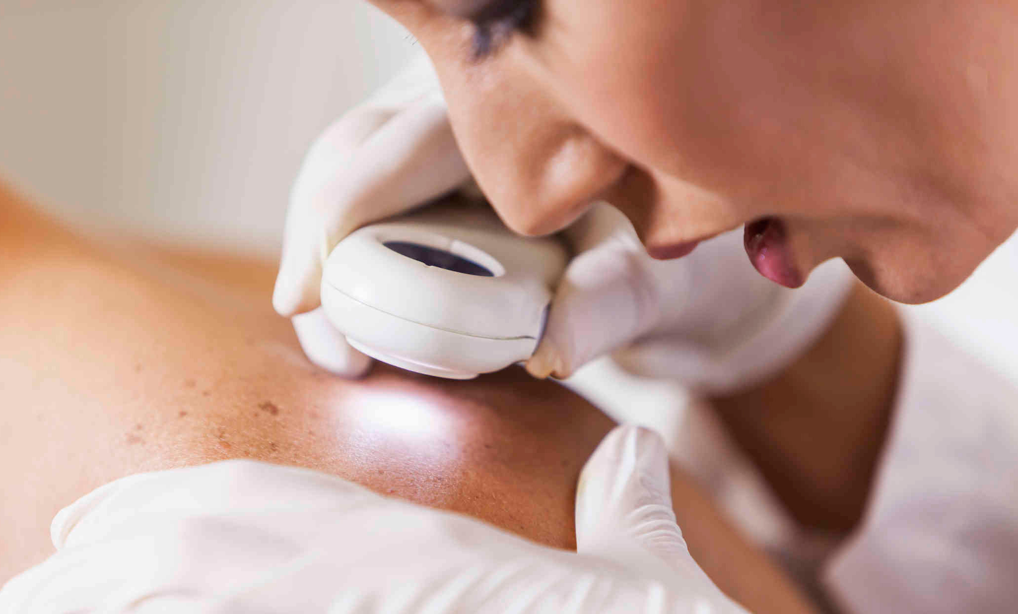 Nueva terapia contra el melanoma reduce a la mitad el riesgo de muerte y recaída