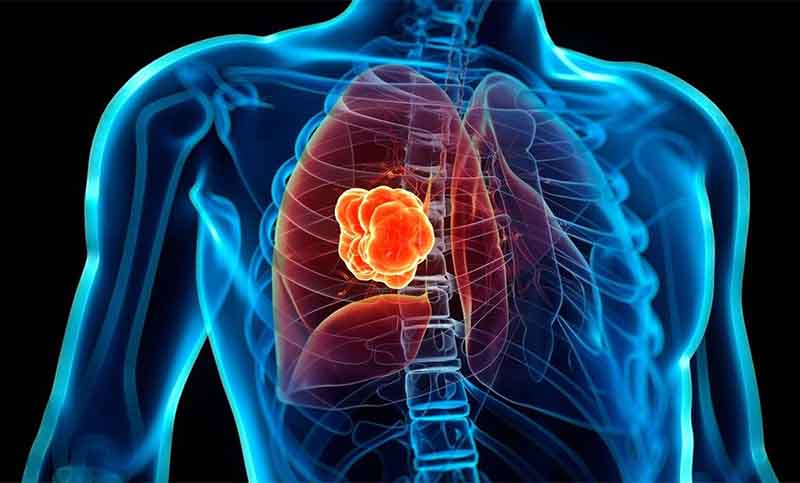 Más de 10 mil personas murieron el año pasado por cáncer de pulmón en Argentina