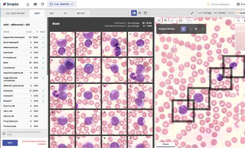 Foto: Imagen de la imagen digital de campo completo pionera de Scopio y el análisis de morfología celular profunda de un frotis de sangre periférica.