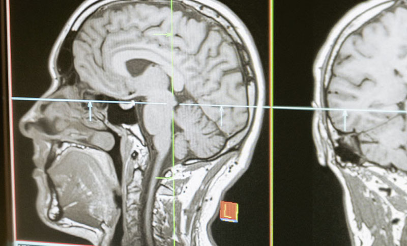 La infección con Covid-19 puede causar cambios en el cerebro